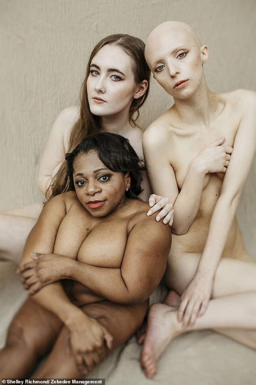 FOTO/ Agjencia e modelingut fotografon gra me aftësi të kufizuara dhe sëmundje të dukshme