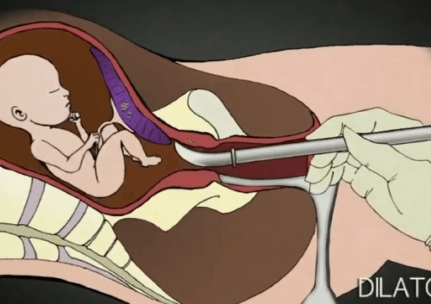 Ja çfarë ndodh me foshnjën gjatë abortit: Kjo video ka prekur zemrat e shumë njerëzve