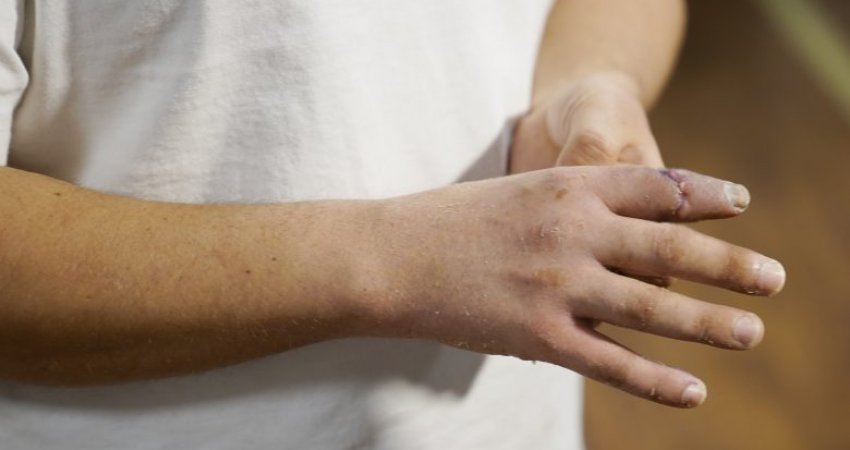 E mahnitshme: Kirurgu ia kthen gishtin e dorës në vend pacientit të tij, 19 orë pasi ai e kishte këputur