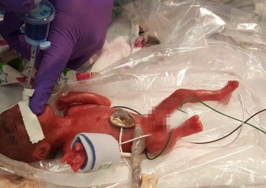 Foshnja më e vogël në botë la spitalin pas 13 muajsh