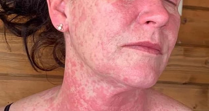 Gruaja pëson alergji nga vaksina e AstraZeneca