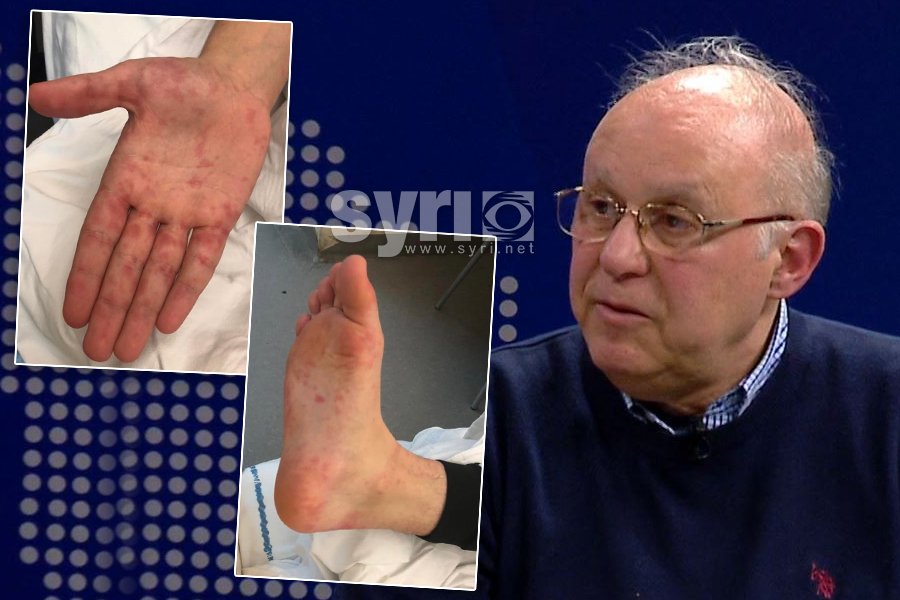 Tritan Kalo: U bënë disa javë që sëmundja Duar-Këmbë-Gojë ka prekur shumë individë në vend