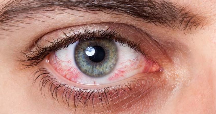 Sytë e skuqur simptomë e COVID-19? Ekspertët kanë një përgjigje