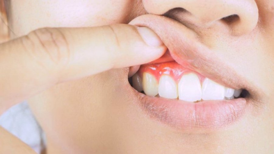  Problemi ‘i zakonshëm’ i gojës mund të jetë duke rritur rrezikun e sëmundjes vdekjeprurëse