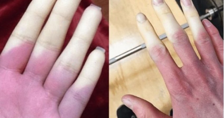 Këto janë simptomat e sëmundjes që ndryshon ngjyrën e gishtërinjëve në të ftohtë