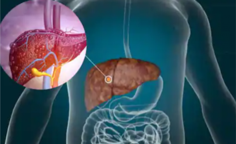 Simptomat e mëlçisë së dhjamosur: 7 shenja të pazakonta që tregojnë se keni probleme me mëlçinë