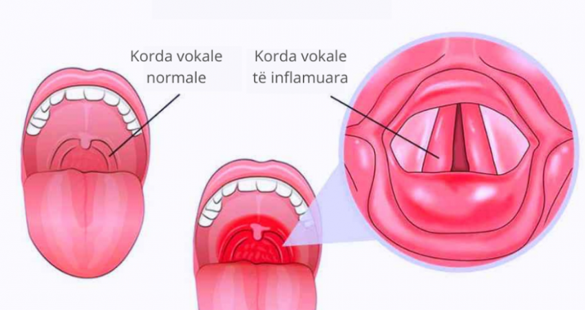 Laringiti është një inflamacion i kordave vokale nga mbipërdorimi, acarimi ose infeksioni