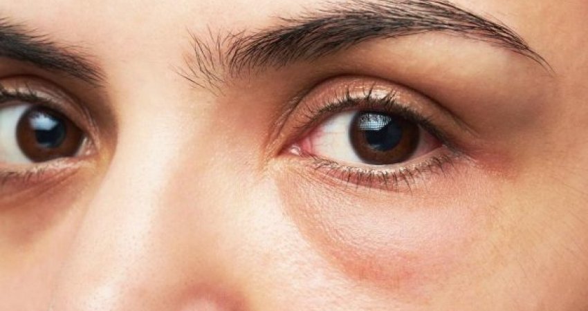 Çfarë e shkakton ënjtjen e syve? 