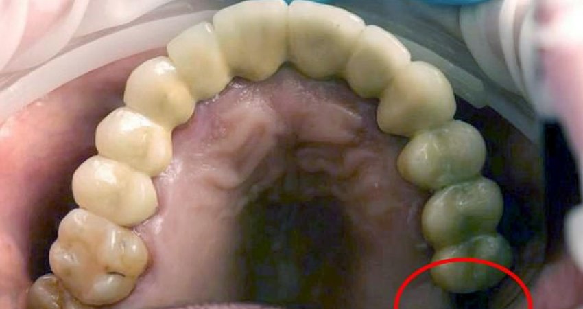E rrallë: Mjekët heqin një dhëmb që po rritej brenda testikujve të 13-vjeçarit