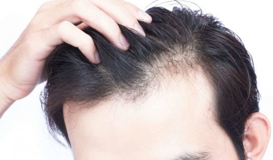Zbulohet simptoma tjetër e Omicron, ja çfarë ndodh me flokët