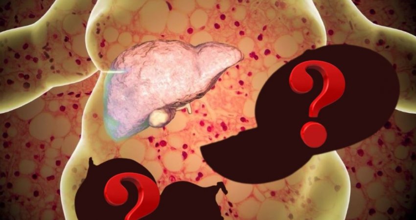Mjekët zbulojnë më në fund sekretin, 3 ushqimet që janë shpëtimi i mëlçisë së dhjamosur