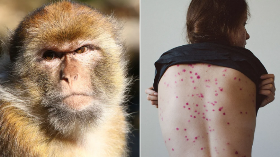 Si transmetohet lija e majmunit, cilat janë simptomat dhe si të mbroheni