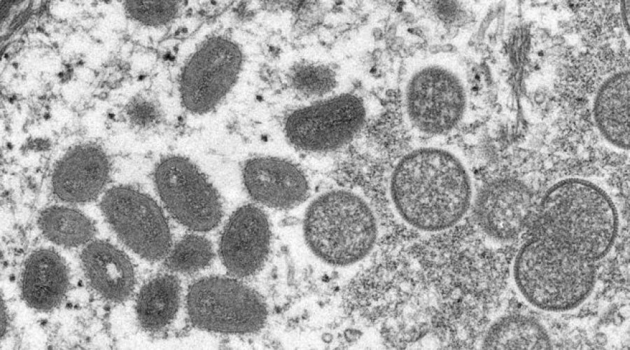 Lija e majmunit, studiuesit italian: gjendet prania e virusit në spermë