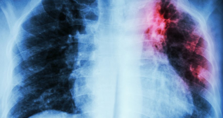 Kolla e vazhdueshme mund të mos jetë COVID-19: Botës i është rikthyer tuberkulozi 