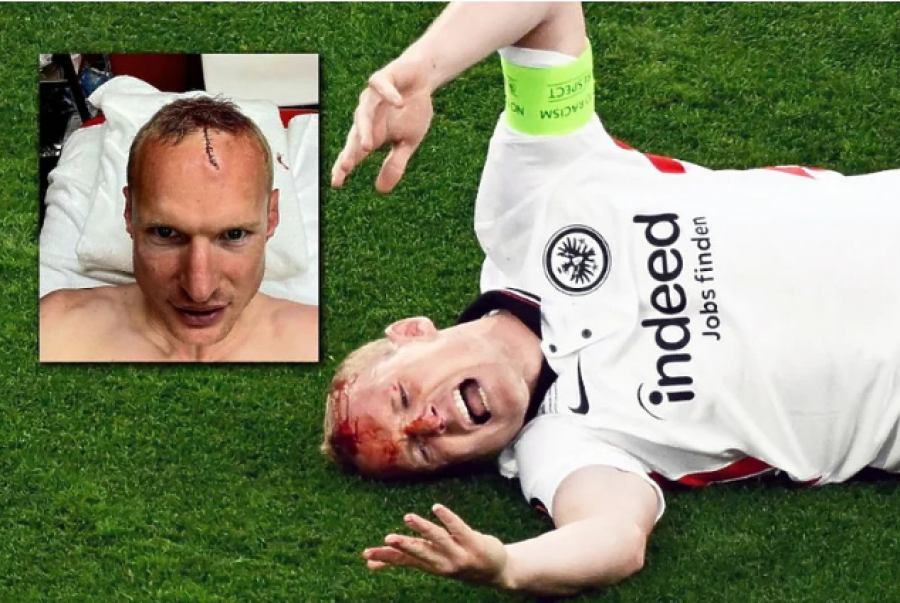 Kapiteni i Frankfurtit publikoi një foto të dëmtimit të tmerrshëm në finalen e Europa League