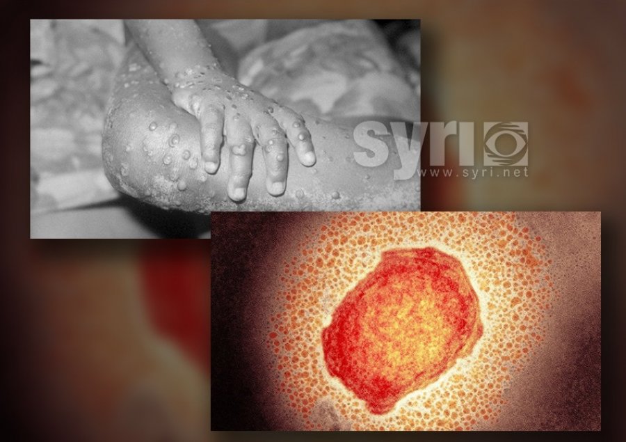 Shpërthimi i lisë së majmunëve/ Çfarë duhet të dini për sëmundjen