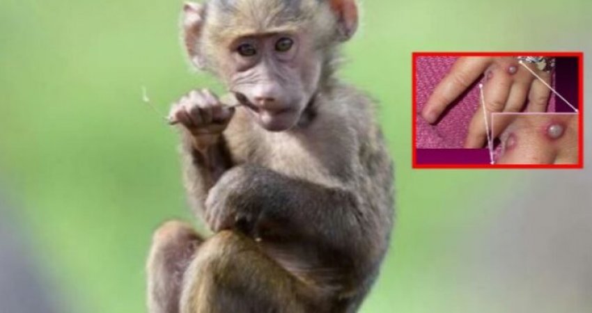 Lija e majmunit: Si transmetohet tek njerëzit, çfarë shenjash shfaqen dhe sa zgjasin simptomat