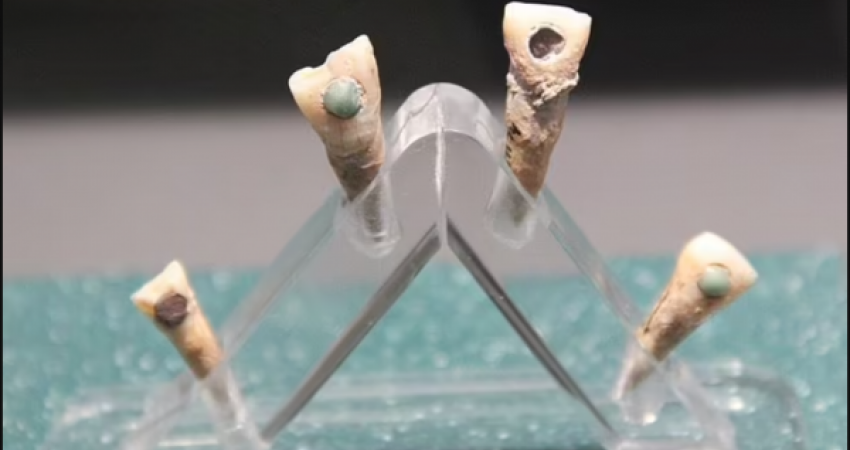 Majat antik përdornin gur kristali për t’i mbrojtur dhëmbët nga infektimet