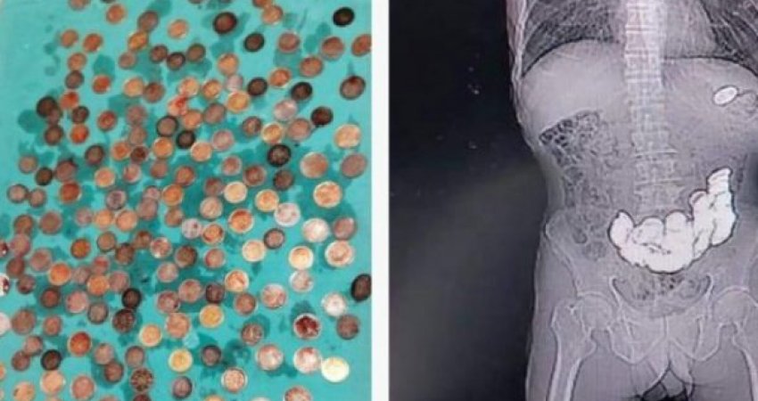 U ankua për dhimbje: Mjekët nxorën plot 187 monedha nga barku i një burri