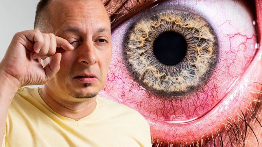 Ndjenja se keni ‘diçka në sy’ mund të sinjalizojë ulçerën – rrezikon humbjen e shikimit