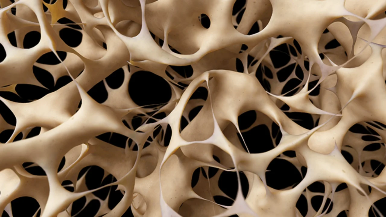 Osteoporoza, shtohet një tjetër faktor rreziku