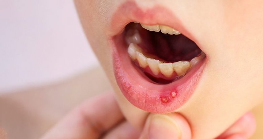 A ka fëmija plagë të bardha në gojë që dhembin? Bëhet fjalë për afta, ja si mund t’ua lehtësoni dhembjet