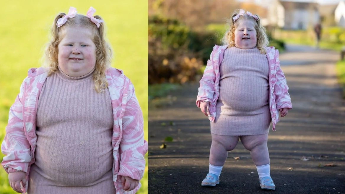  Vajza 5-vjeçare që peshon 45 kg vuan nga një sindromë që e bën vazhdimisht të uritur
