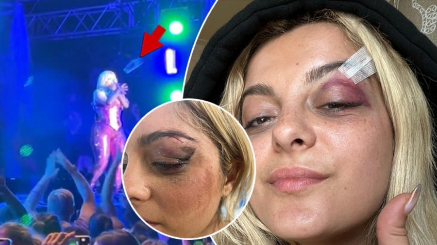 Bebe Rexha reagon pas sulmit në koncert, publikon fotot e qepjes në fytyrë: Jam mirë