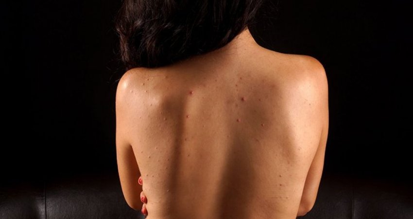 Dermatologia e Kendall Jennerit zbulon: Ja se si njëherë e përgjithmonë t’i eliminoni aknet nga shpina! 