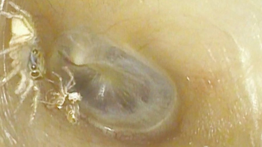 Mjekët zbulojnë merimangën duke u zvarritur dhe lëshuar lëkurën në veshin e një gruaje