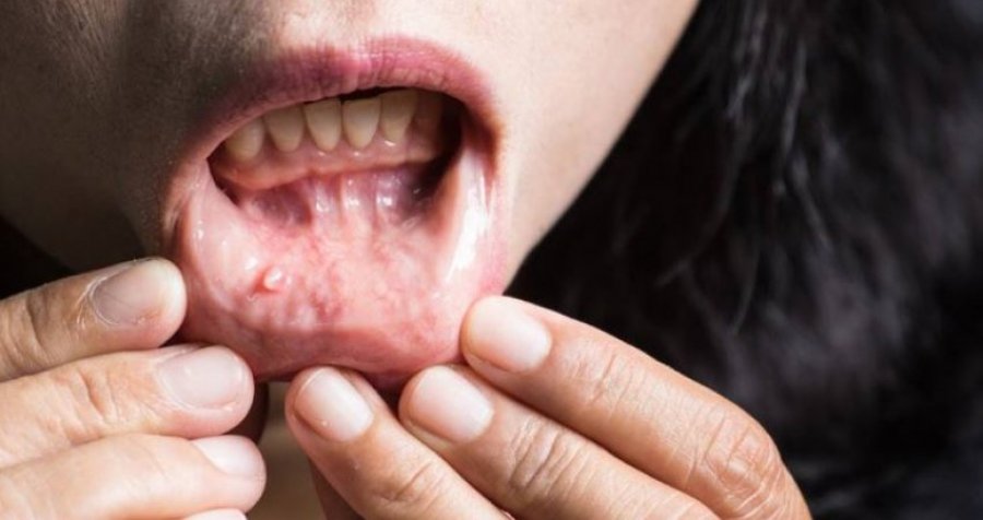Gjashtë shenjat paralajmëruese të kancerit të gojës