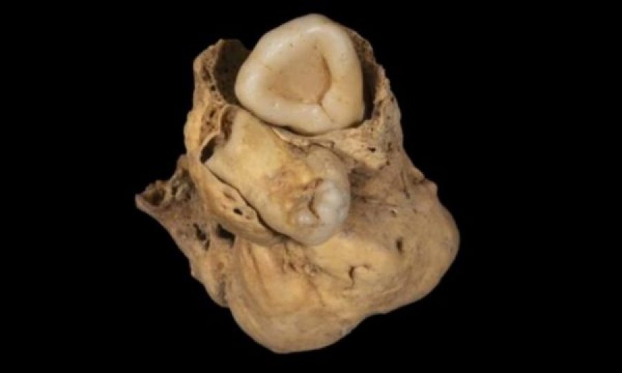 Një tumor me dhëmbë është zbuluar në Egjipt në eshtrat e gruas së lashtë 