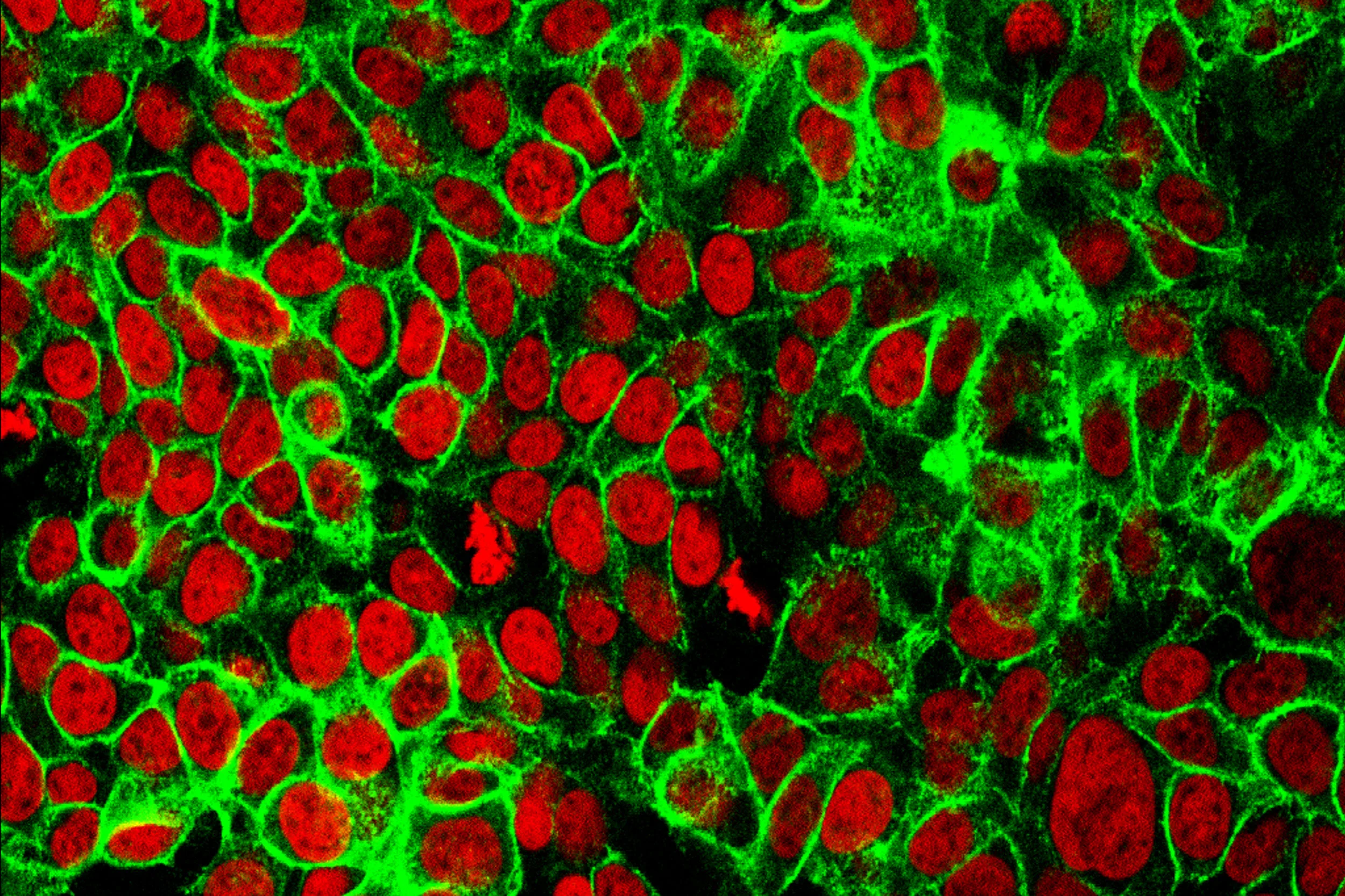 Zbulohet qeliza kyçe që lufton kancerin e zorrës së trashë