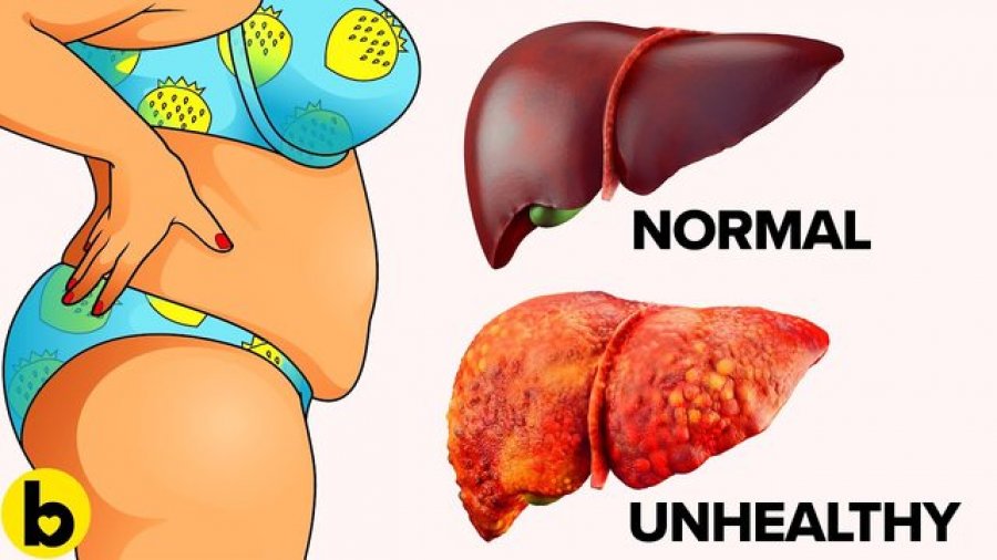 Duhet të shkoni te mjeku urgjentisht sapo i dalloni, këto 4 shenja tregojnë që mëlçia juaj është e tejmbushur me toksina