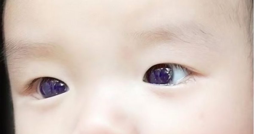 Fëmijës 6-muajsh i ndryshohet ngjyra e syve pasi merr ilaçin anti-COVID