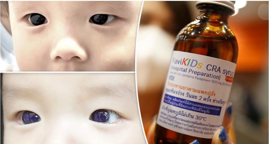 Ilaçi kundër koronavirusit 'ndryshoi përkohësisht' ngjyrën e syve të një foshnje
