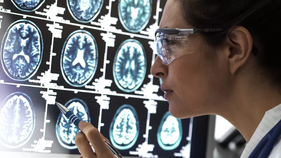 Ishte mister më parë, shkencëtarët kanë kuptuar se si qelizat e trurit vdesin në sëmundjen e Alzheimerit