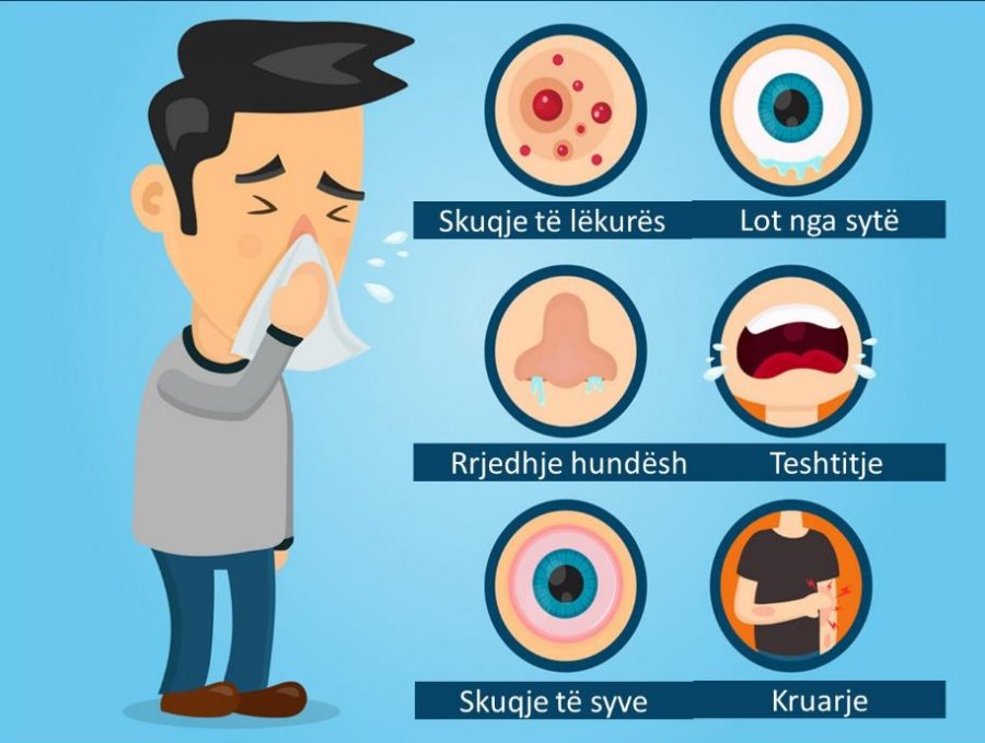 Shenjat dhe simptomat e alergjive stinore