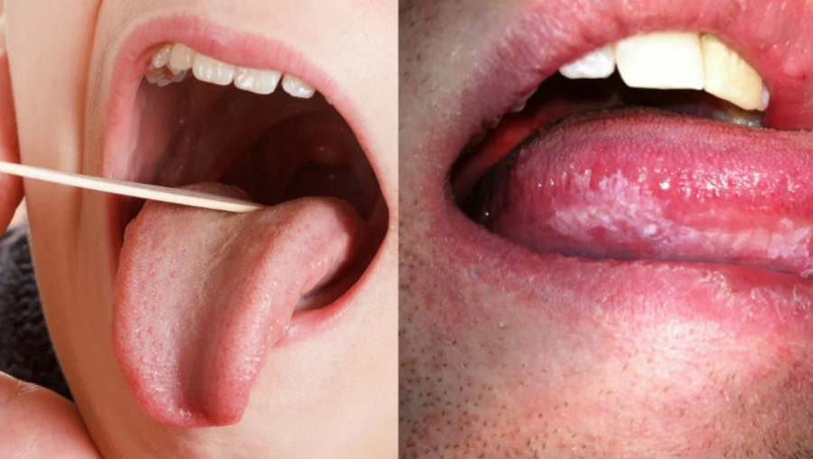 Kanceri i gojës, kokës dhe qafës/ Këto janë shenjat e para paralajmëruese që nuk duhet t’i neglizhoni