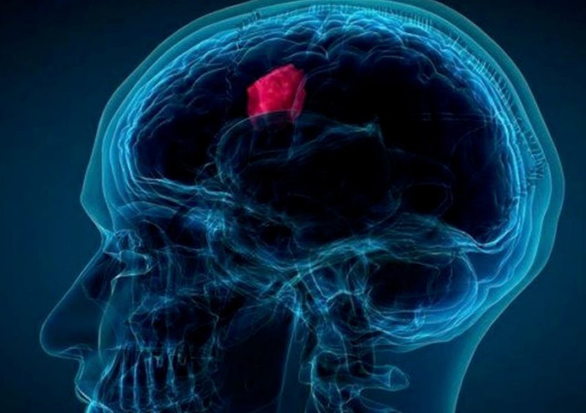 Përmirëson diagnozën dhe trajtimin e sëmundjes, çfarë tregon testi i parë për zbulimin e turmorit në tru 