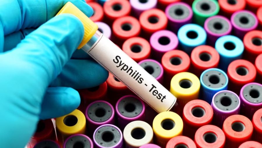 Alarm në SHBA, shtohen rastet me sifiliz në të gjitha grupmoshat, përfshirë edhe të porsalindurit
