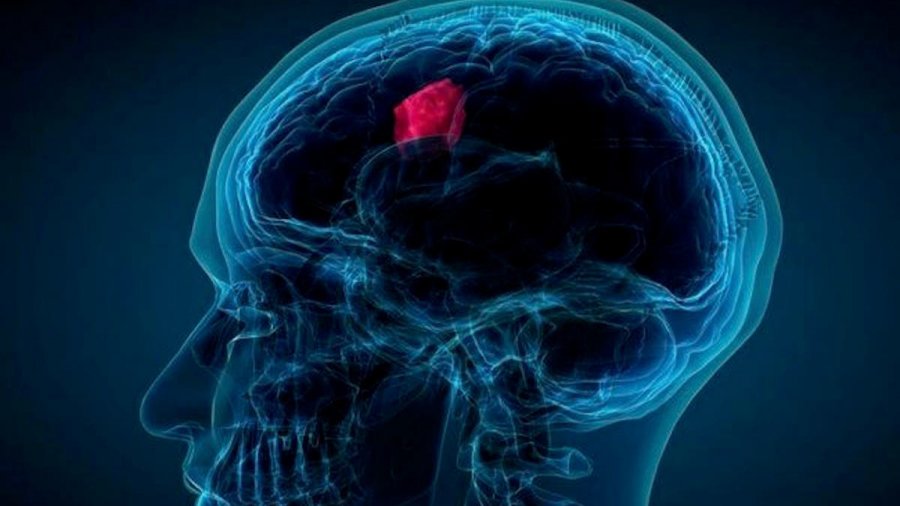 Përmirëson diagnozën dhe trajtimin e sëmundjes, çfarë tregon testi i parë për zbulimin e turmorit në tru 