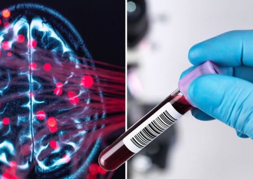 Analiza e gjakut mund të zbulojë në fazë të hershme sëmundjen e Alzheimer
