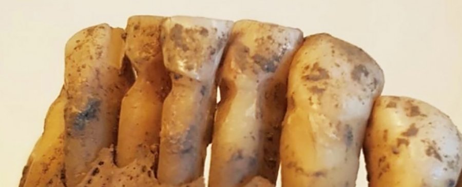 Shkencëtarët studiuan 3000 dhëmbë vikingësh dhe zbuluan stomatologji çuditërisht të avancuar