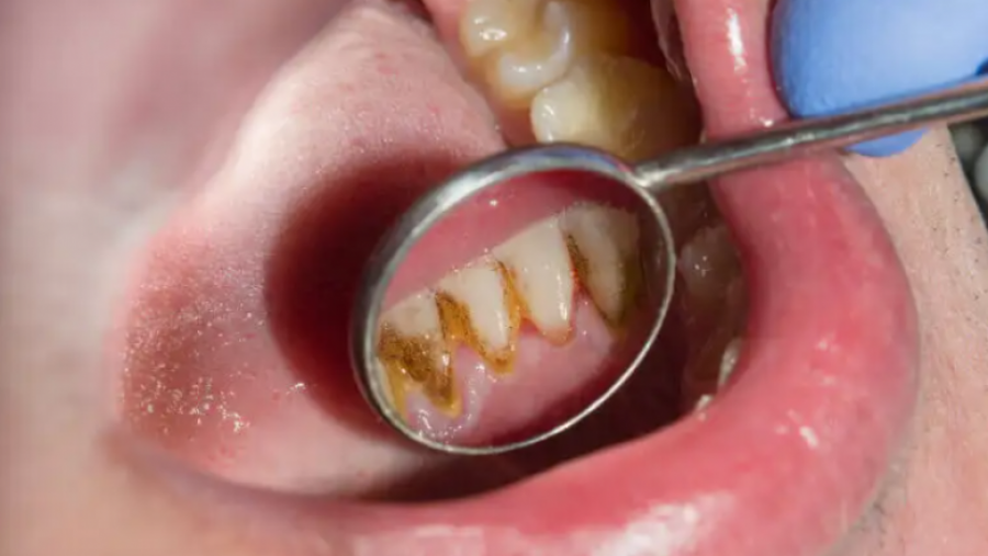 Ju formohen gurët e zi në dhëmbë? Si t’i largoni dhe si mund të parandaloni formimin e tyre