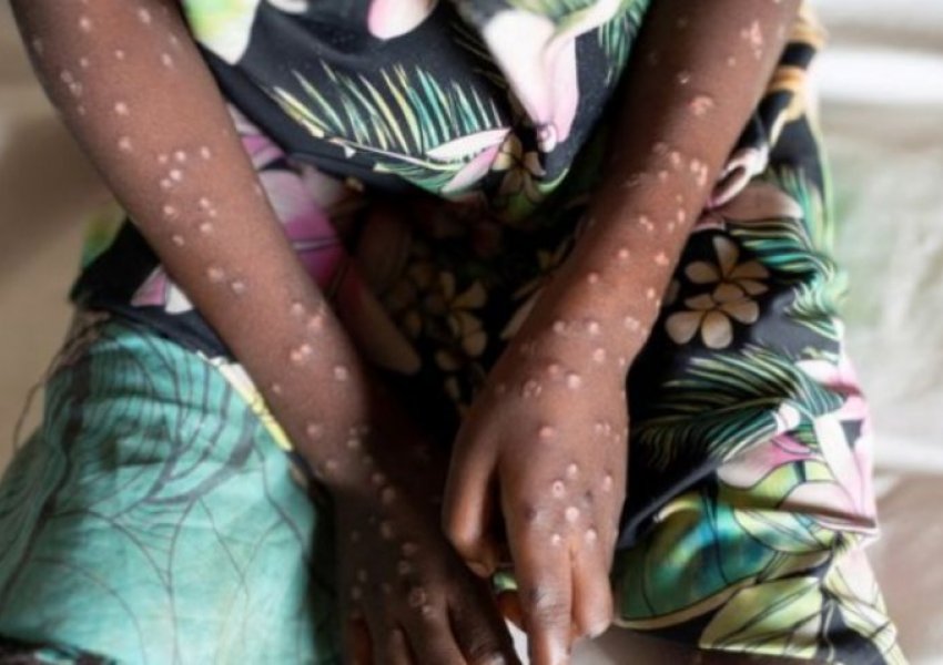 Një tjetër shtet afrikan konfirmon raste të Lisë së majmunit