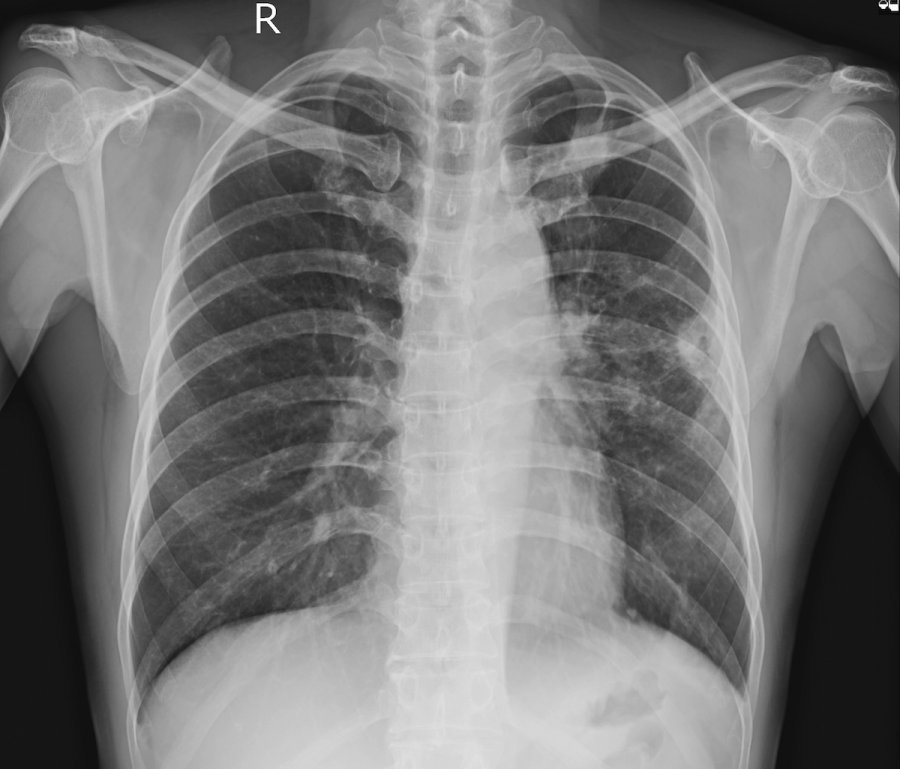Noduli pulmonar: çfarë është, simptomat dhe si trajtohet