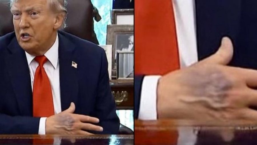 Shenja dhe mavijosje në dorën e Trump ngrenë sërish shqetësime për shëndetin e tij