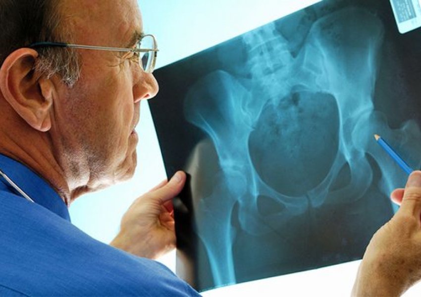 Gjashtë shenjat paralajmëruese të osteoporozës, si ta shmangni