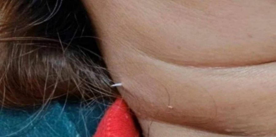 Tmerr në tryezë: Hala e peshkut ngec në fytin e një gruaje dhe pas disa ditësh...del jashtë qafës